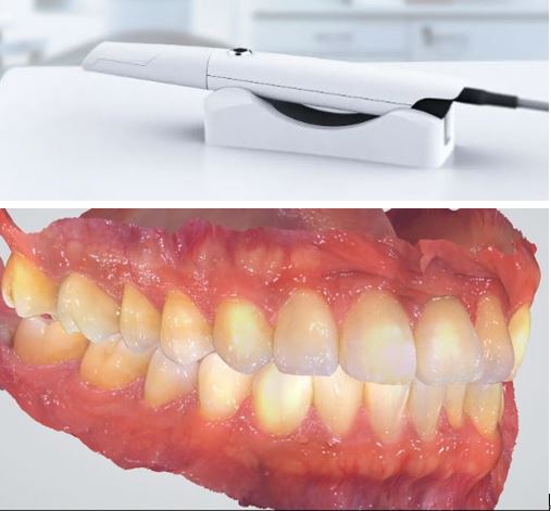 口腔内スキャナー